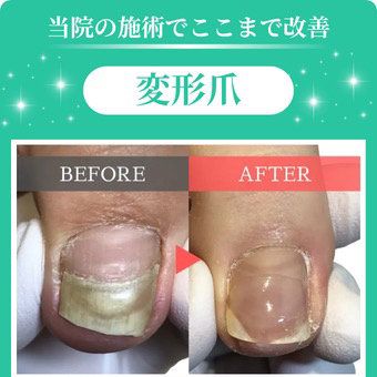 【分厚い爪・変形爪・深爪1指+爪切り】