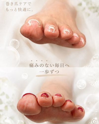 【巻き爪ケア 初回キャンペーン👣】キャンペーン価格 ¥9000