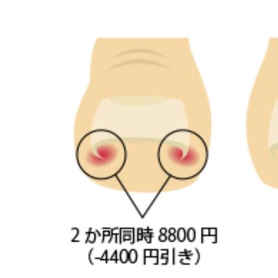 巻き爪ケア