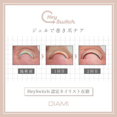 巻き爪ケア