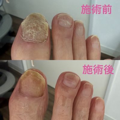 変形爪ケア