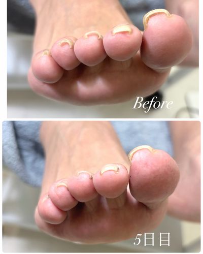 フット巻き爪補正