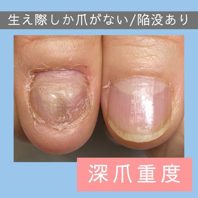 自爪育成○クリア 深爪/重度