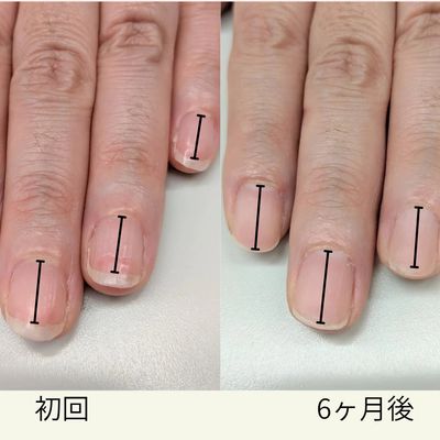ジェル矯正モニター