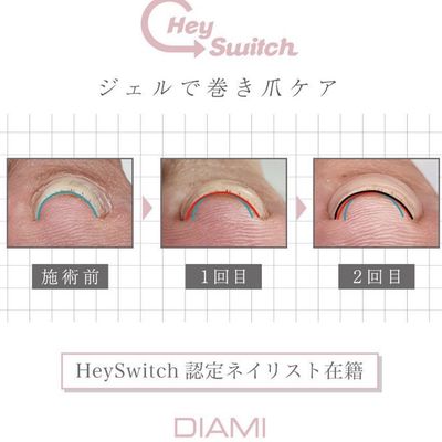 巻き爪改善コース【1本】