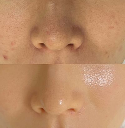 【究極の肌質改善】最新ピーリング「セラピール」◎剥離なしで驚きの水光肌
