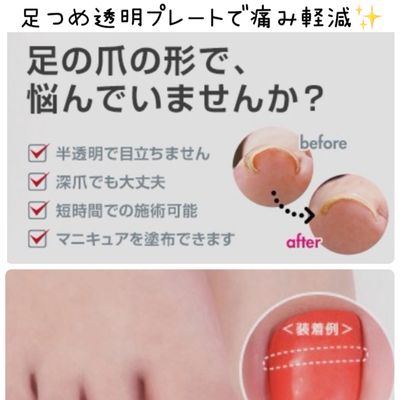 #巻き爪 🦶#透明プレート #足爪 1箇所 #肥厚爪 #陥入爪 予防✨
