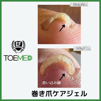 巻き爪ケア　1本　