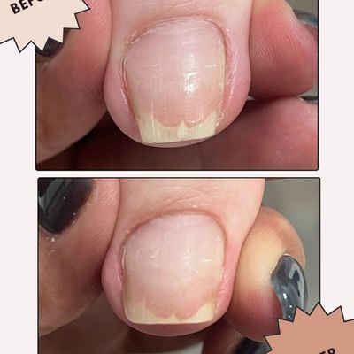 【 オプション 】巻き爪緩和ケア