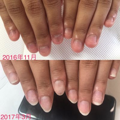 ７月限定⭐️ご新規様‼️ナチュラル深爪矯正10本♡¥7980