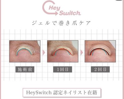 巻き爪改善コース【2本】