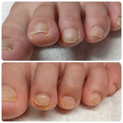 フットネイルカット