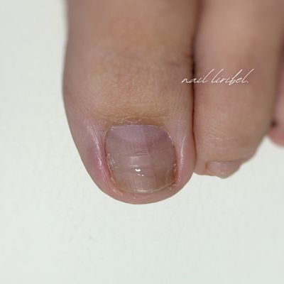 痛くない巻き爪ケア1本