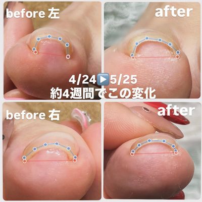 痛みにさよなら、ジェルで巻き爪補正🩰˚˖𓍢