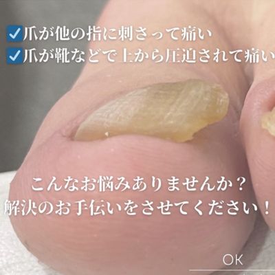 変形爪・肥厚爪補正