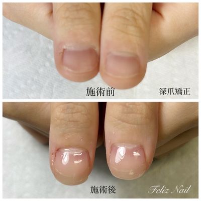 【1日1人限定価格】人生変わる深爪矯正