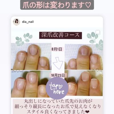 深爪育成　軽度コース(本当にピンクの部分が伸びる❤︎とお喜び頂きされます💕)