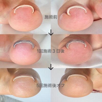フット巻き爪矯正