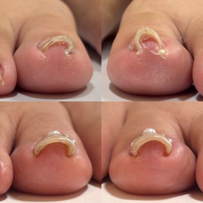 巻き爪ケアジェル🦶🏻(親指1本)
いつの間にか改善している😳痛みのない施術👌