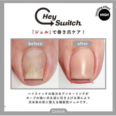 巻き爪ケア（親指2本）