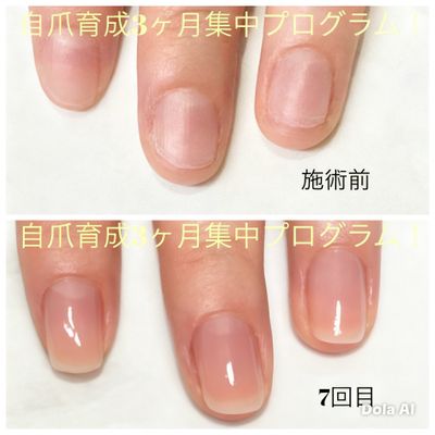 自爪育成3ヶ月集中プログラム