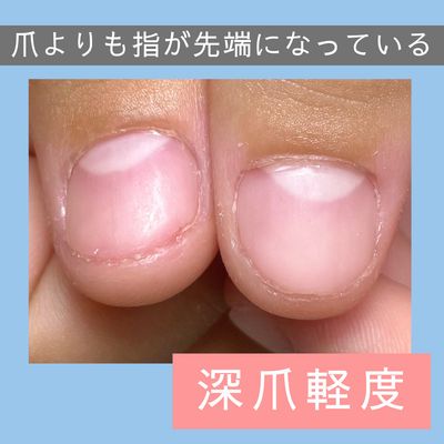 自爪育成○クリア 深爪/軽度