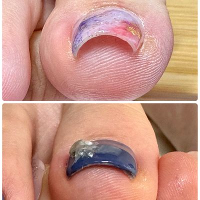 巻き爪補正