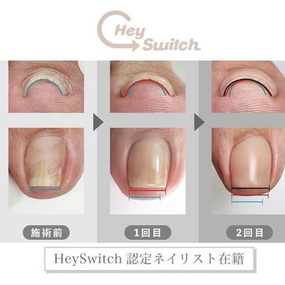 巻き爪ケア1本