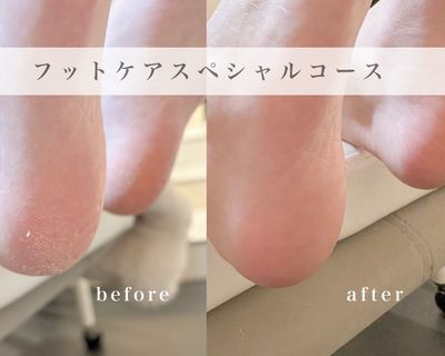 【フット】角質ケア