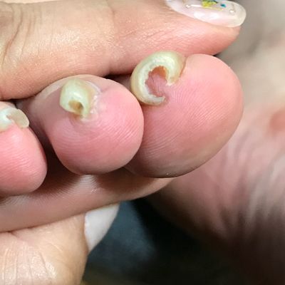 フット巻爪ケア(爪1本あたりのお値段)