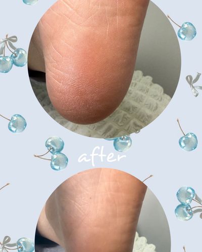 フット角質ケア