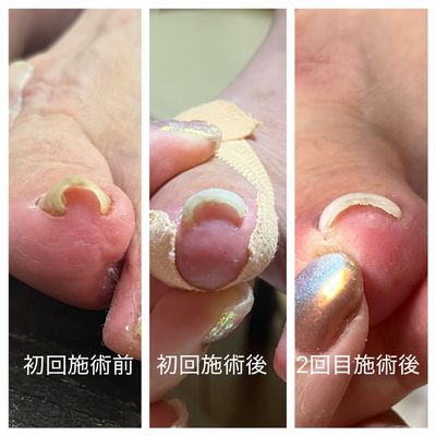 巻き爪ケア