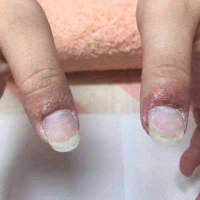 【ネイルアレルギーの方専用】パッチテスト