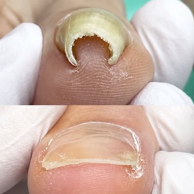 フット 巻き爪 汚れケア（かかとのケアではありません）