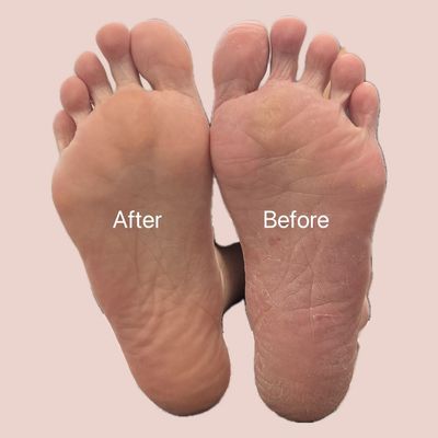 フット角質ケア（プロテケアネイル）