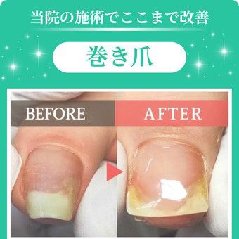 【巻き爪・陥入爪矯正1指+爪切り】