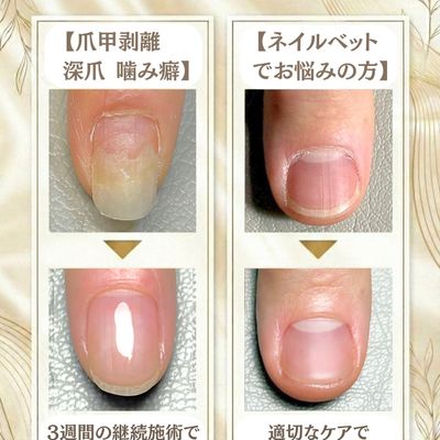 深爪、爪甲剥離