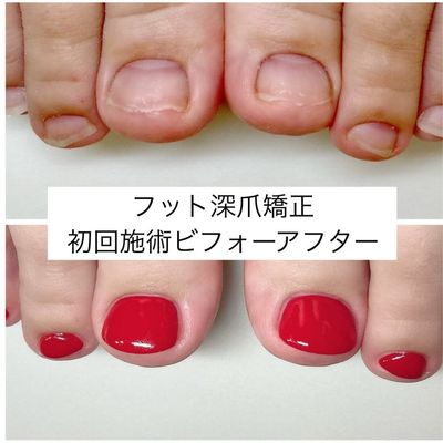 フット深爪矯正