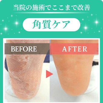 【足裏タコ・魚の目・踵の角質ケア＋爪切り】