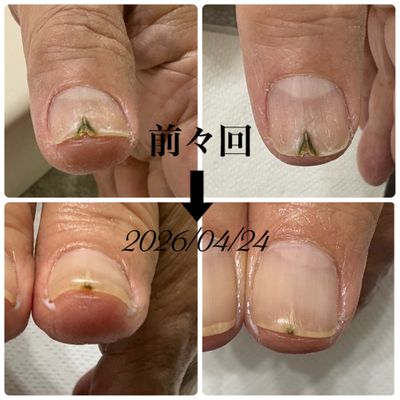 【爪の補強】