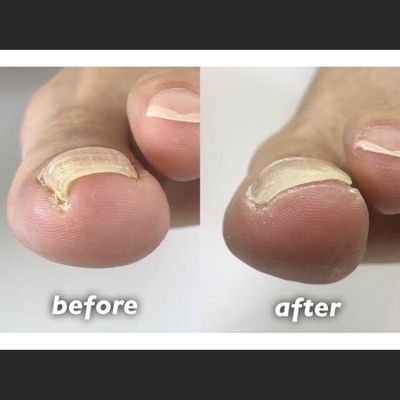 foot 巻き爪矯正👣🍀 初回❕