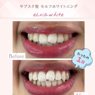 【当店人気No1】セルフホワイトニング(9分2セット)