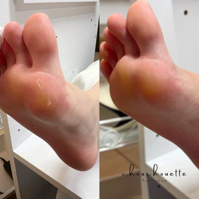 フット角質ケア