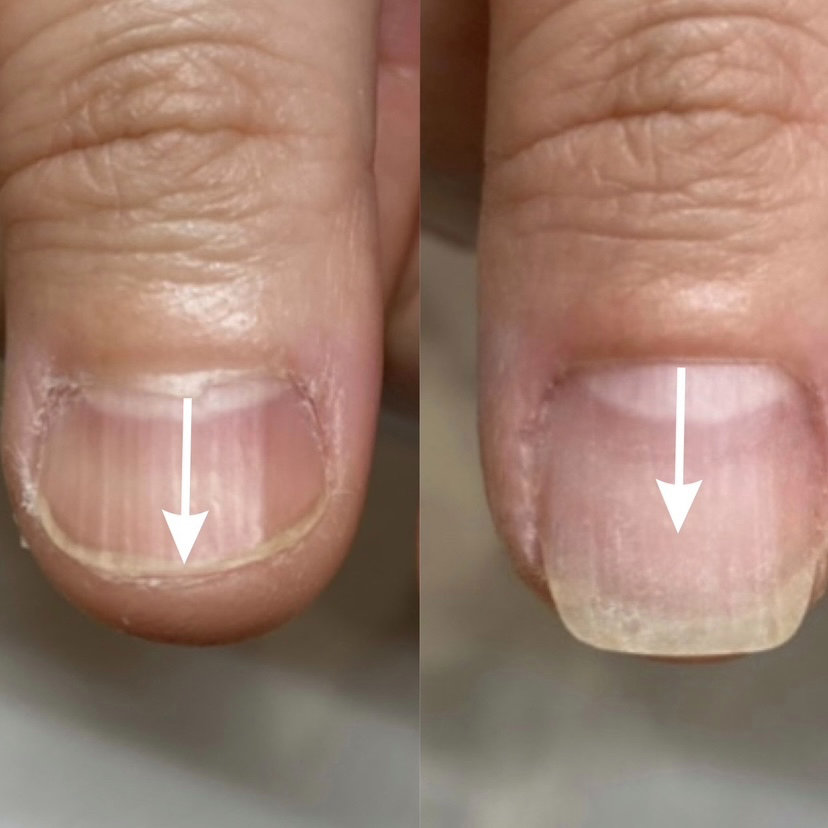 palm.nail