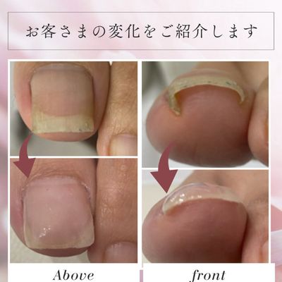 巻き爪補正ケア　¥5000〜/1本(フットバス、爪周りのお掃除ケア込み)