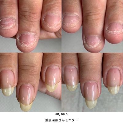 重度深爪モニター　¥15000→¥8500（3回まで）