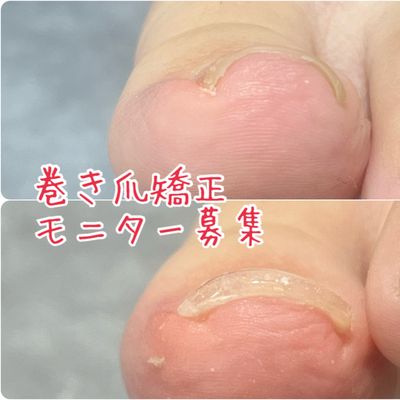 巻き爪矯正(モニター)