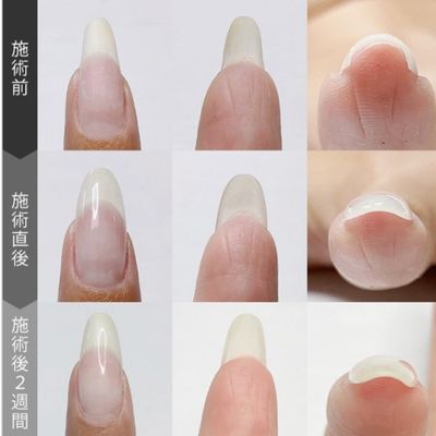 ハンド/巻き爪ケア1本