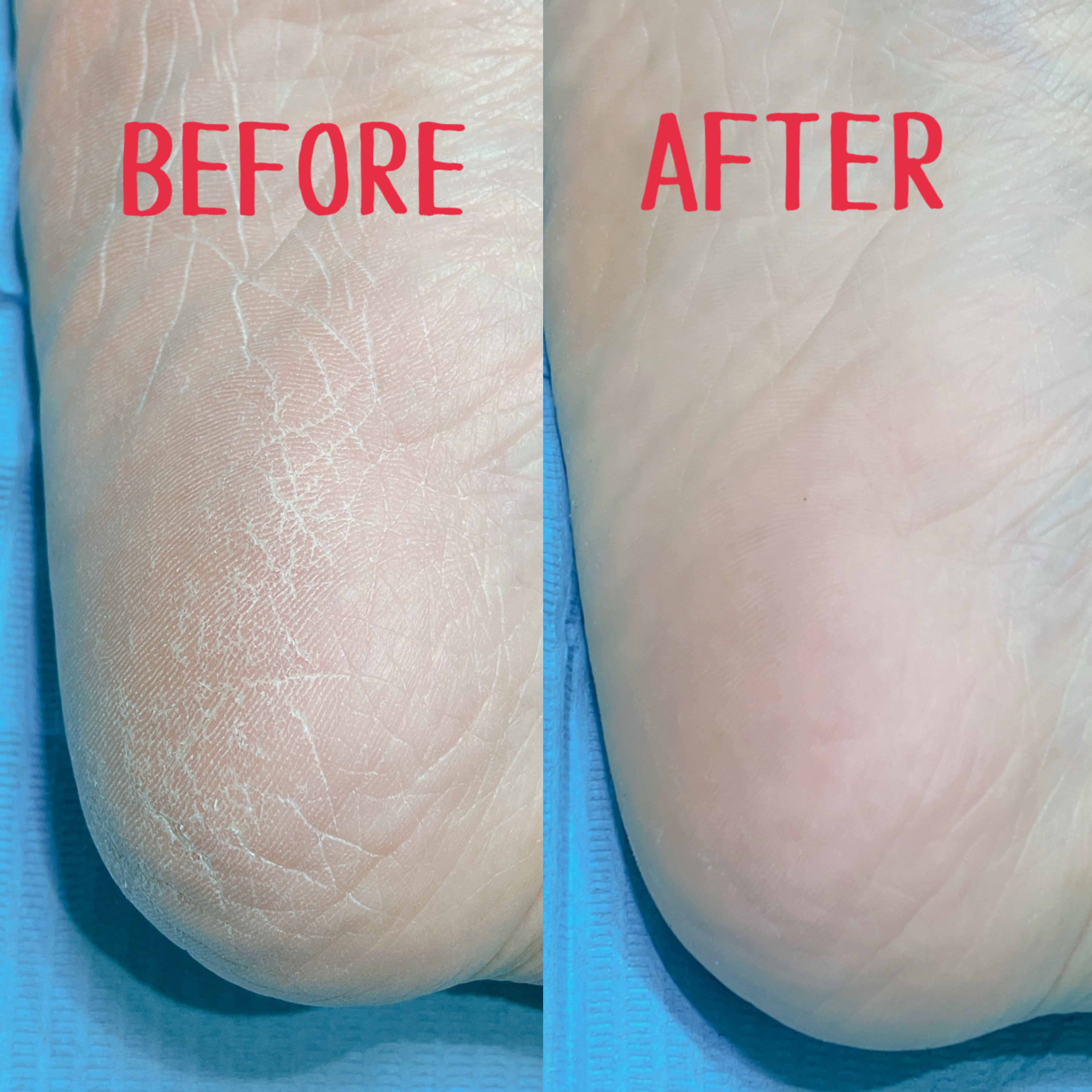 【つるつるふわふわ】足裏かかと角質ケアコース