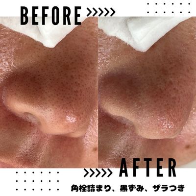 Rami毛穴ケア